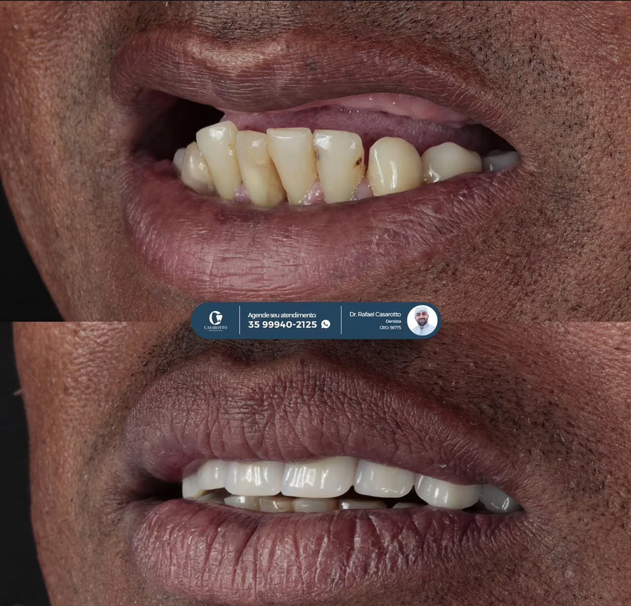 Reabilitação com implantes