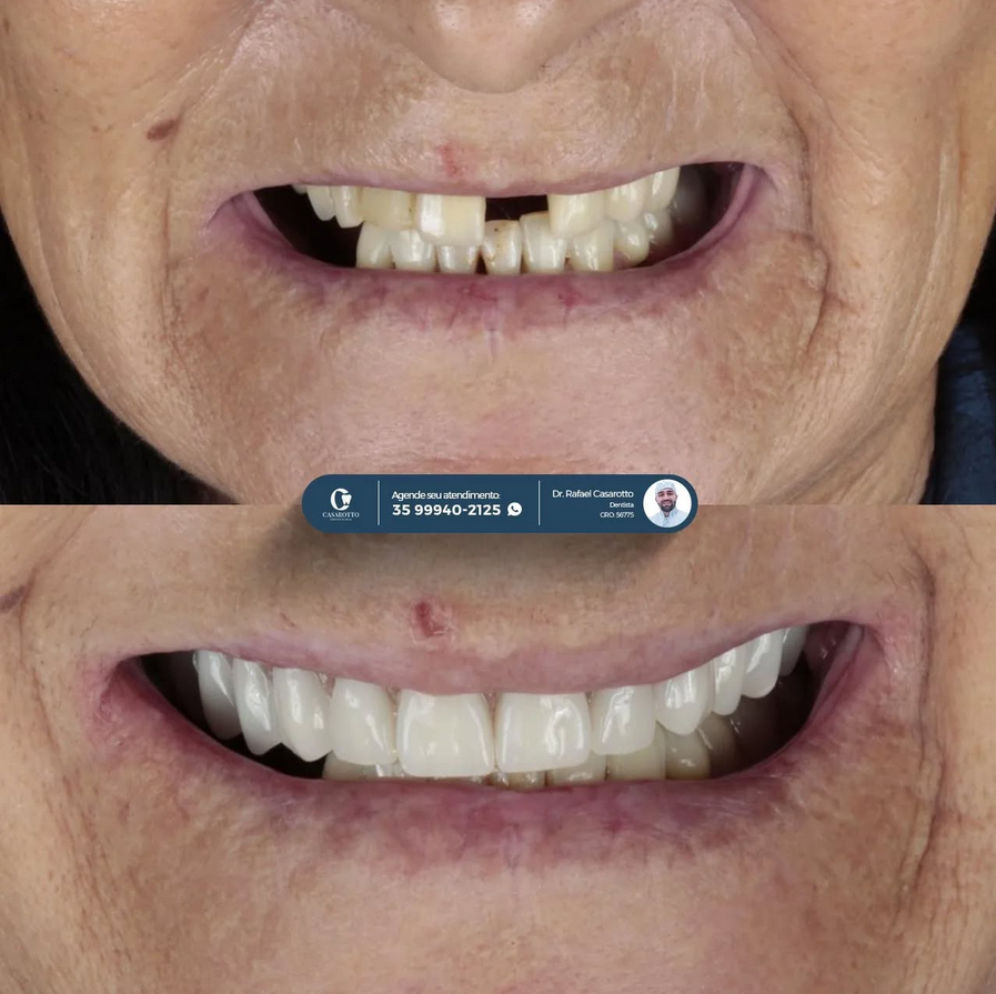 Lentes de contato dental