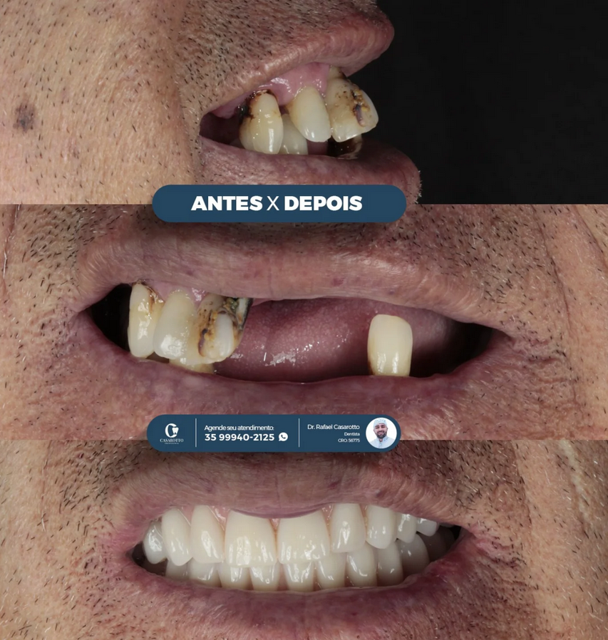 Prótese sobre implante
