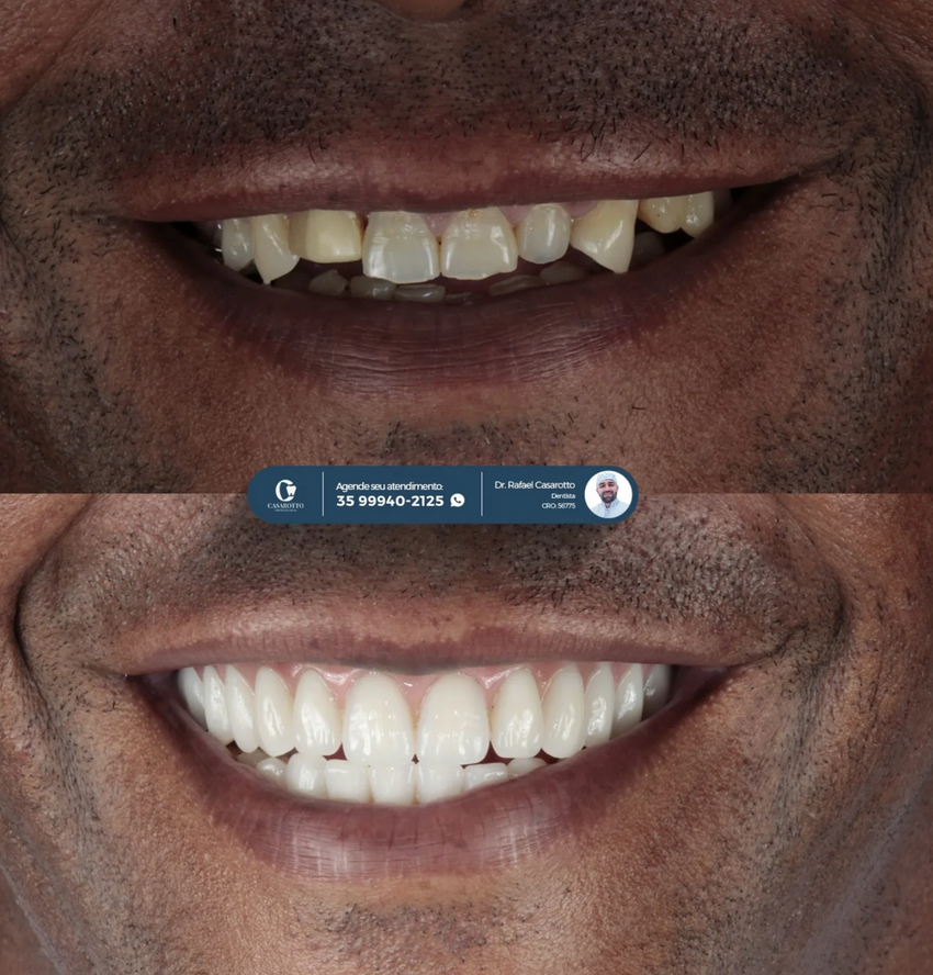 Harmonização do sorriso